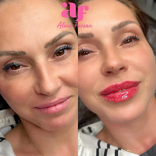 Lip Filler Lip Filler