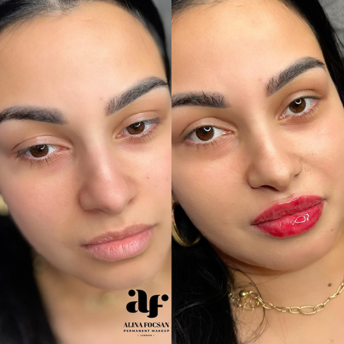 Lip Filler Lip Filler